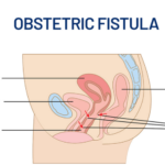 ECOWAS Commits to Combating Obstetric Fistula in Liberia