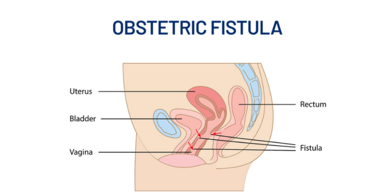 ECOWAS Commits to Combating Obstetric Fistula in Liberia